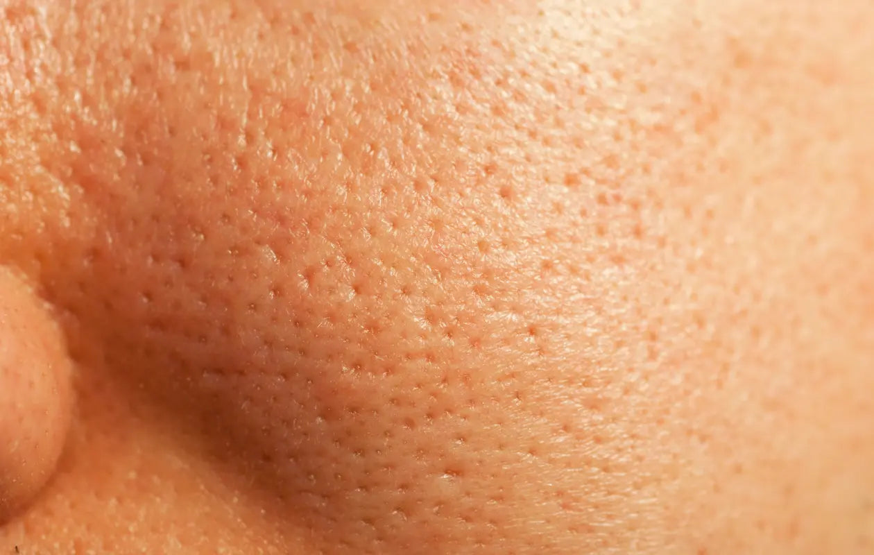 Why Do My Pores Look Bigger? 3 Patterns Explained AcneologyHQ™