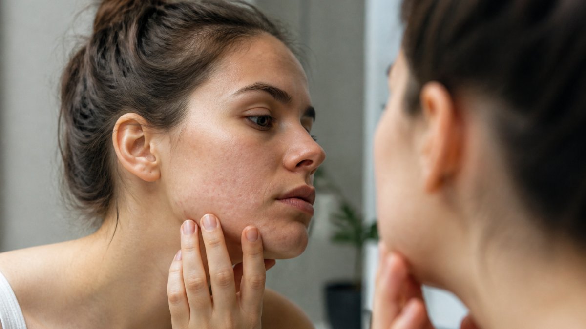 What Hormonal Pimples Look Like: A Visual Guide